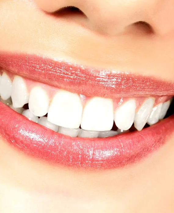 Bleaching Melchior & Hilbert Zahnärzte Remscheid